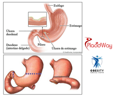 Slider image (5) Obesity Surgical Center | Dr. Jorge Reyes Mendiola